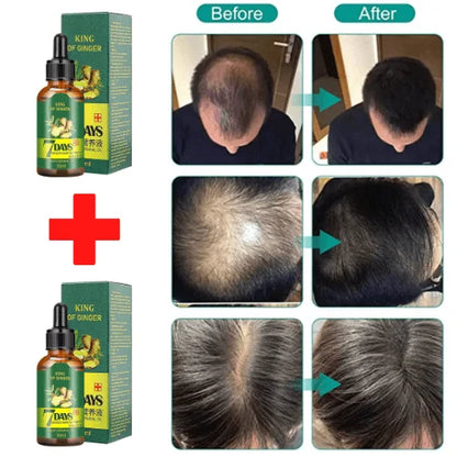 Ginger Germinal Oil, Ginger Hair Growth Serum, Hair Growth Oil, Hair Growth for Women & Men Stronger, Thicker, Longer Hair Thinning Treatment  30 ML